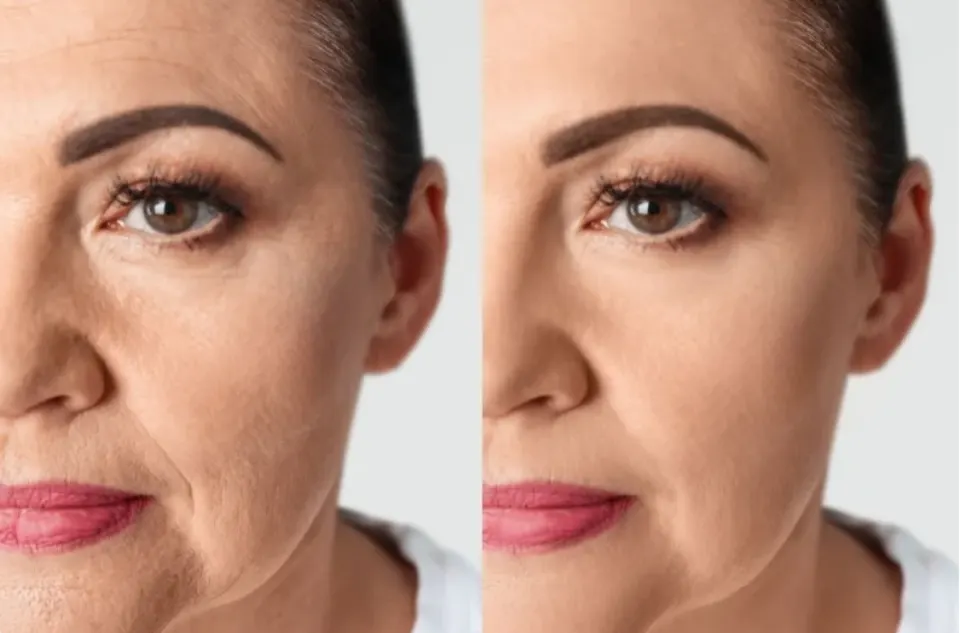 Tratamento de Bioestimuladores de Colágeno na Cairós Prime Clinic