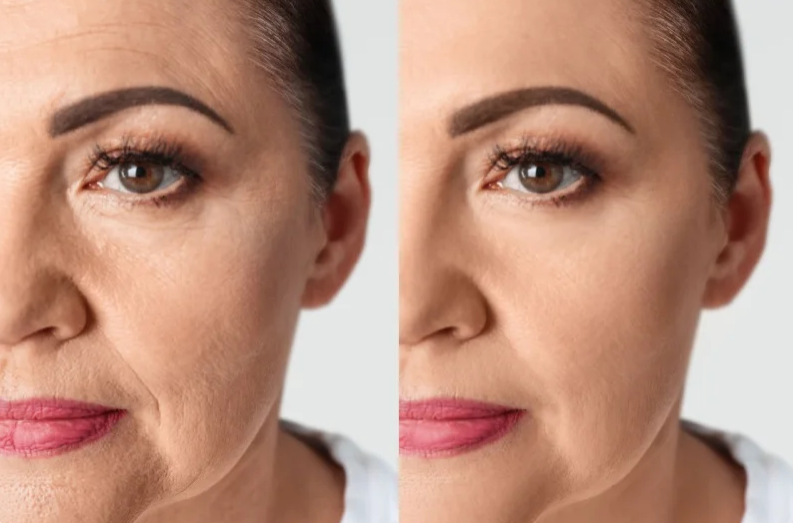 Bioestimuladores de colágeno — Cairós Prime Clinic, Vila Matilde